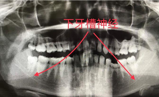 为啥别人拔智齿会脸肿,拔智齿下唇和下牙齿没知觉怎么办