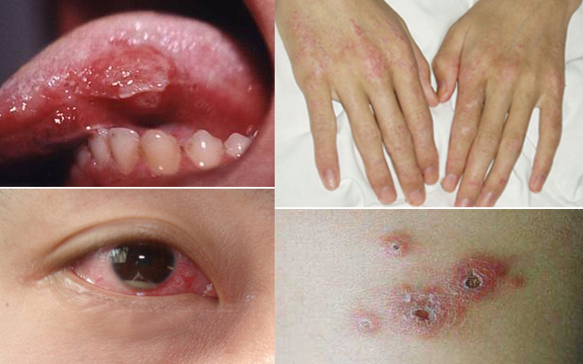 迁延数年的口腔溃疡为何要小心白塞氏病?