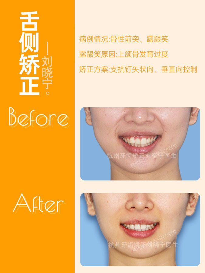 杭州牙齿矫正丨露龈笑怎么办?全面告别露龈笑的4大方法