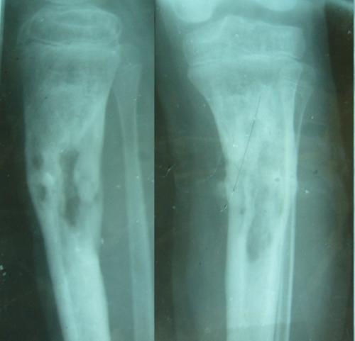 骨髓炎和慢性骨髓炎的区别,骨感染是不是就是骨髓炎