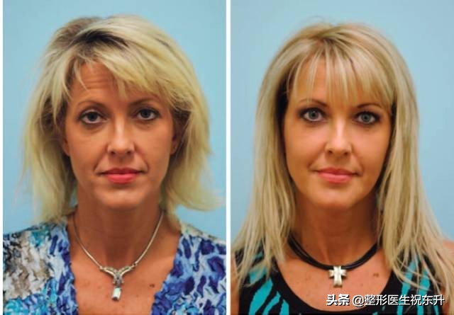 脂肪填充面部减龄部位,面部凹陷脂肪填充演示