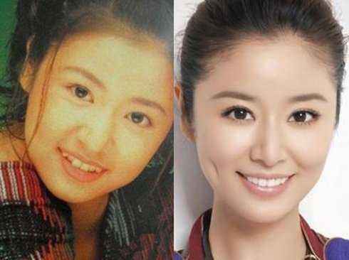 成人矫正期间牙齿松动正常吗,成年人牙齿矫正会松动吗