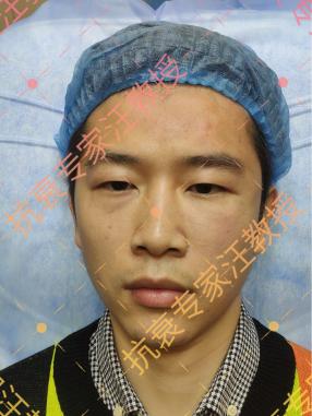 中医治眼袋大泪沟深自己怎么调理,二个方法解决眼袋泪沟七天有效