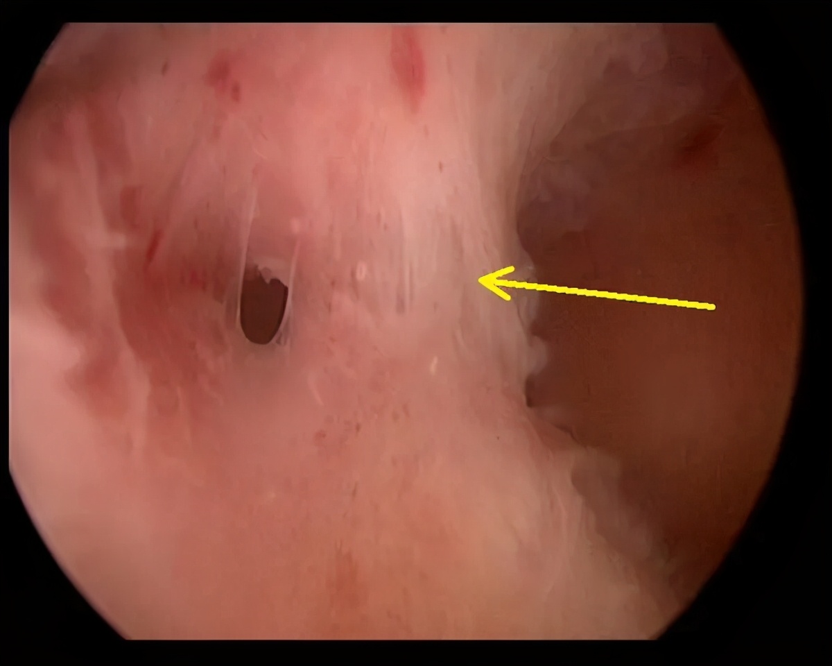 做过人流的会被发现吗,以前做过人流能看出来吗