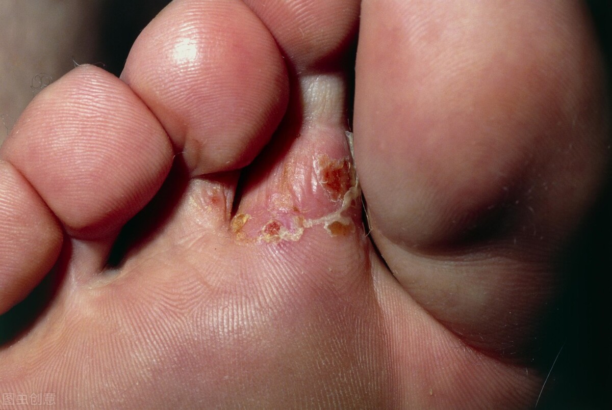 脚气脚怎么修,治疗脚气足癣的方法