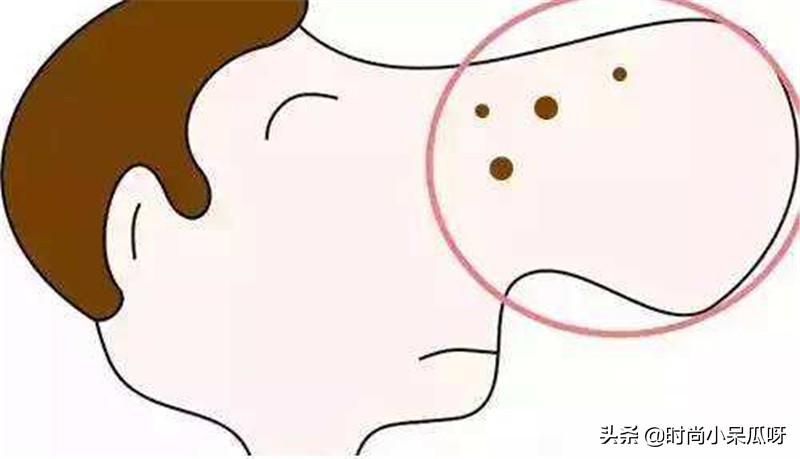 如何有效去黑头并有效修复毛孔,不伤皮肤的去黑头方法