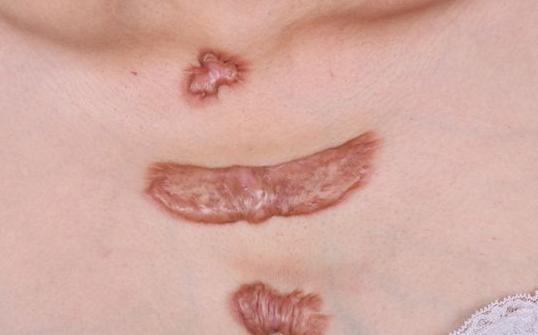 疤痕疙瘩不治疗要紧吗,疤痕疙瘩不治疗能治好吗