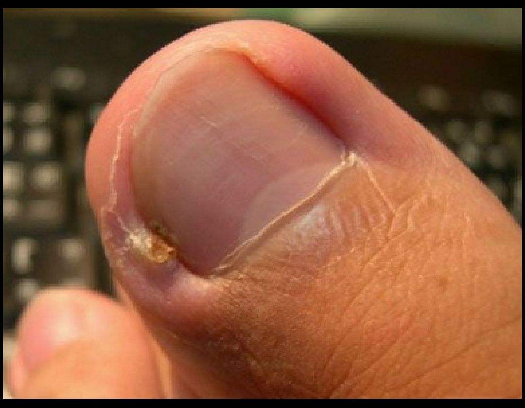 甲沟炎怎么办教你一招解决,甲沟炎怎么办用什么抗生素