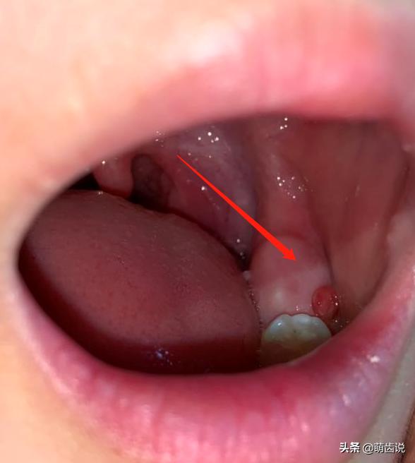 宝宝喊牙疼上嘴唇肿了是什么原因,宝宝牙疼为什么晚上疼得厉害