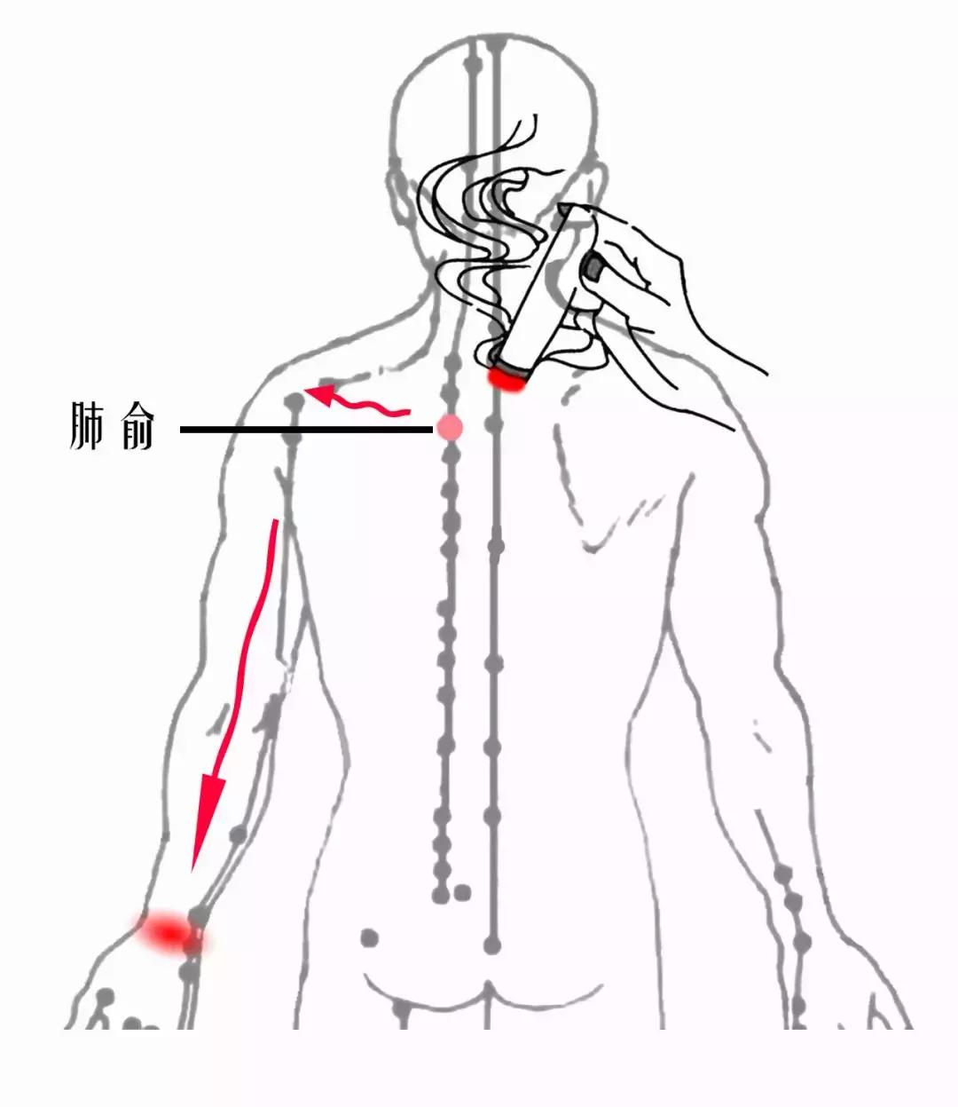 颈椎腰腿痛针刀,针刀颈椎病