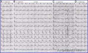 早期心梗心电图能查出来吗,警惕这种要命的心电图表现