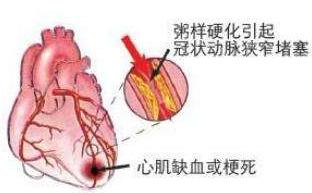 冠心病突发周围人如何急救,有冠心病的人平常表现