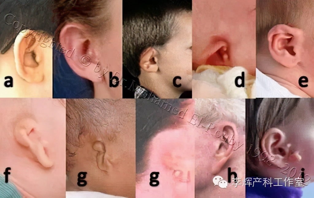 剖宫产憩室手术知情同意书,剖宫产手术同意书