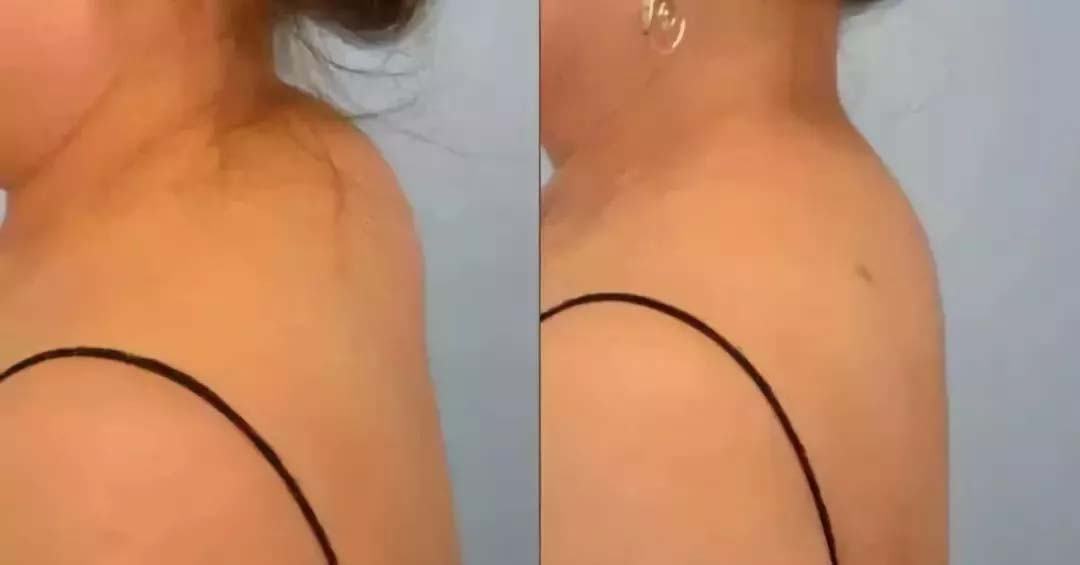 富贵包与个人的习惯,富贵包对人有什么影响吗