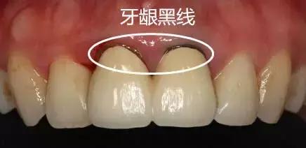 不含重金属的烤瓷牙有吗,诊所100元一颗的烤瓷牙有毒吗