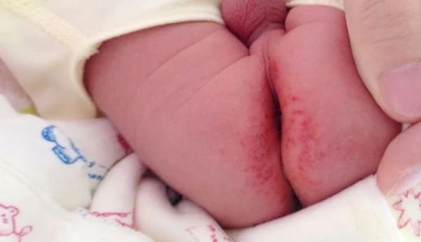 宝宝脖子上的痱子起脓包,痱子发红是快好了吗