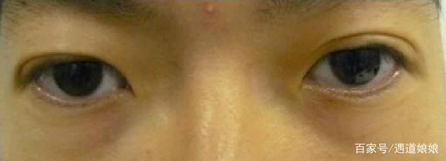 黑眼圈的自救指南有哪些,黑眼圈自救指南看这里