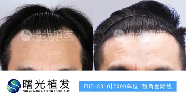 合肥脱发植发,合肥曙光植发