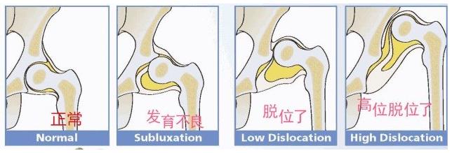 什么是成人髋关节发育不良,成人髋关节发育不良贴吧