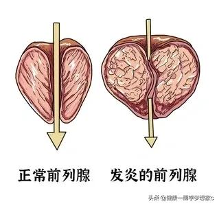 慢性前列腺炎尿频尿急输什么药好,尿频尿急前列腺炎中医治疗