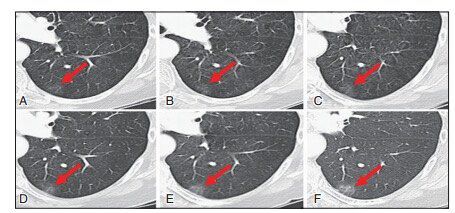 肺结节中的ggo代表什么,肺结节ggn与ggo有什么区别