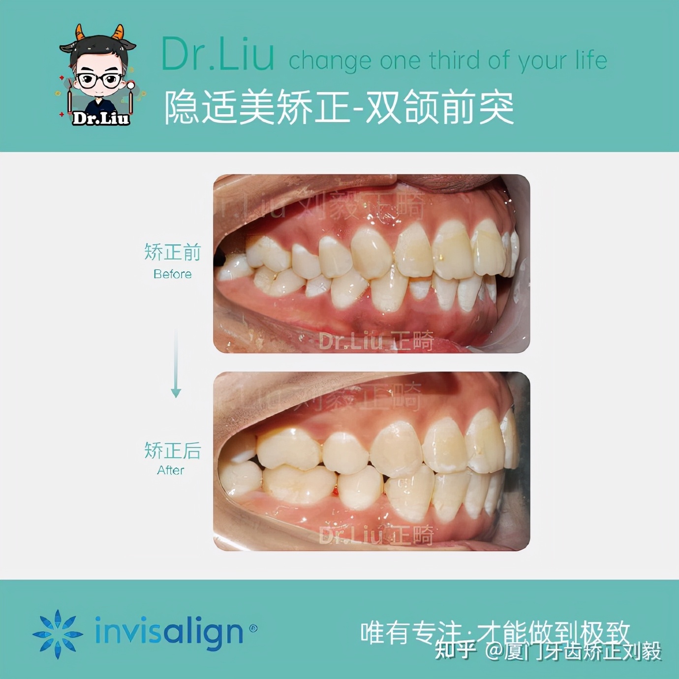 厦门成年人牙齿舌侧矫正,下嘴唇厚且外翻牙齿矫正