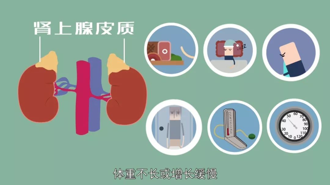 先天性肾上腺素组织增生症,肾上腺皮质增生羟化酶缺陷症