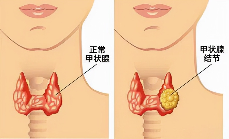 甲状腺结节心慌发热失眠,甲状腺手术成功案例