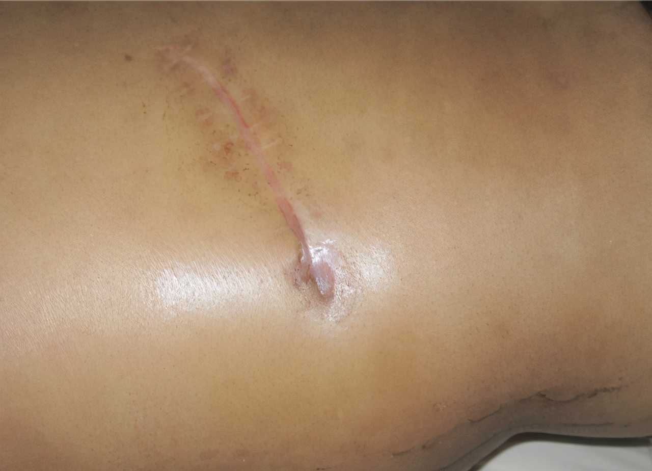 腰椎结核用哪种药比较好,腰椎结核的患者要注意什么