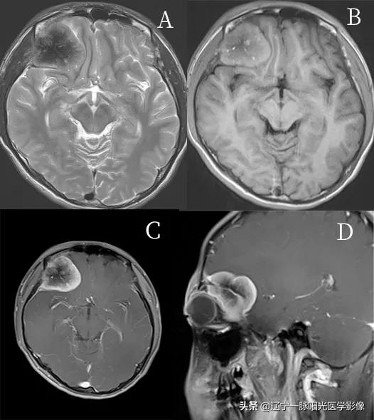 眼部疾病诊断有哪些,眼部病变有哪些症状