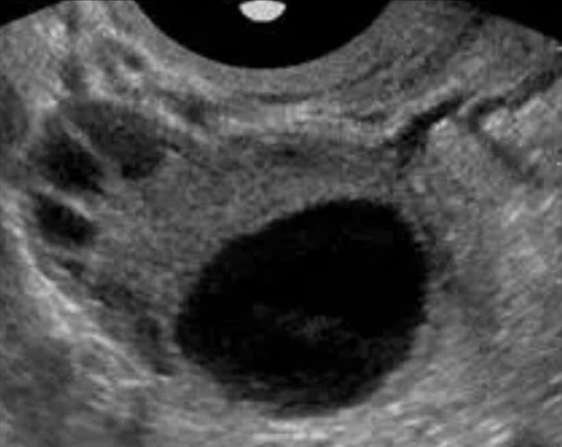 卵泡监测好就说明输卵管是通的吗,卵泡监测备孕流程