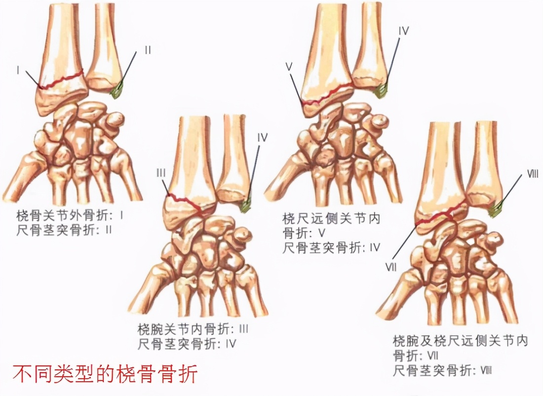 桡骨远端骨折后该怎么做康复,桡骨骨折后康复教程