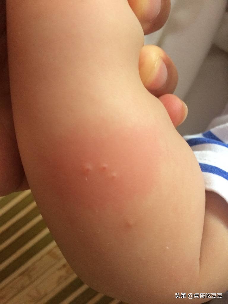 小宝宝被蚊子咬了怎么处理好一点,宝宝被蚊子咬了的处理方法
