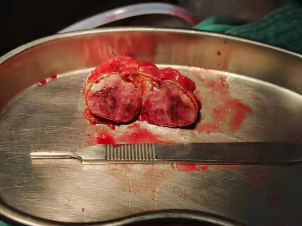 嗜铬细胞瘤泌尿外科,泌尿外科恶性肿瘤