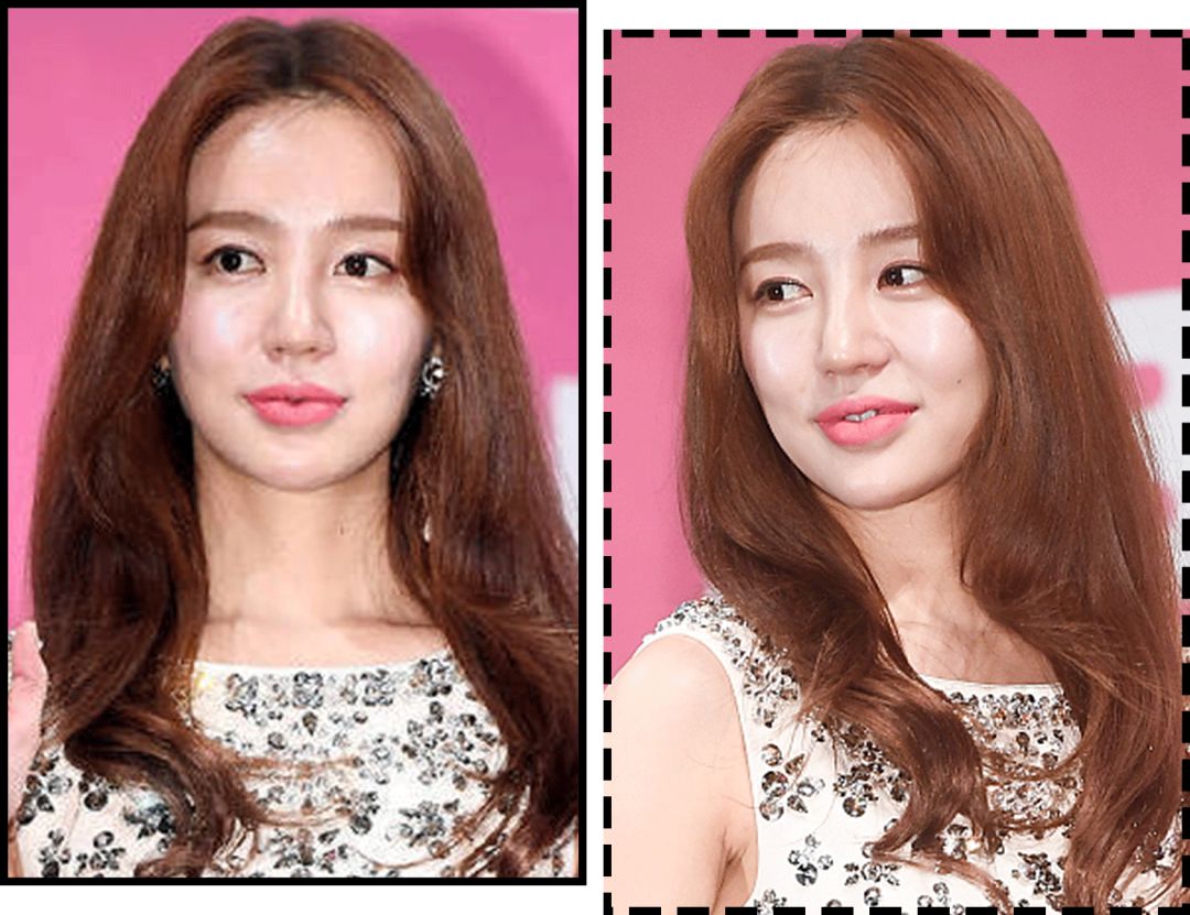 花10万打玻尿酸经验总结,花了将近十万打玻尿酸没有效果