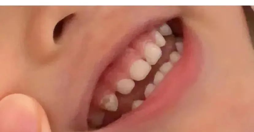 牙齿脱矿用含氟牙膏有用吗,一岁半宝宝牙齿脱矿怎么办