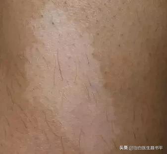 医生无法确定无色素痣还是白癜风,无色素痣误诊白癜风