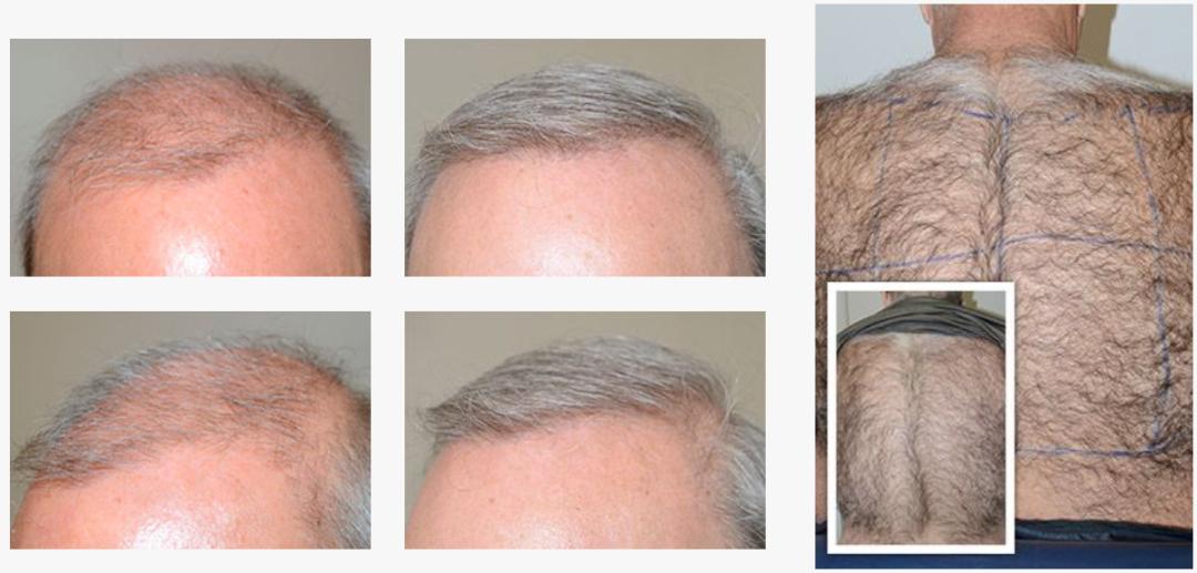 胸毛腿毛的毛囊能植发吗,胸毛可以用来植发嘛