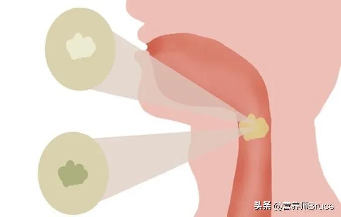 不咳嗽长期痰多,长期痰多咳嗽怎么办