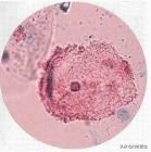 阴道炎会不会造成输卵管堵塞，影响要孩子吗？