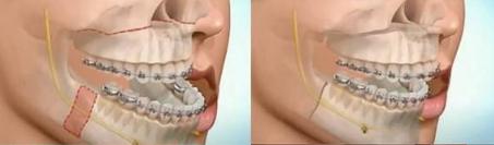 改变凸嘴的方法,如何改变凸嘴的方法