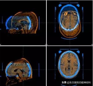 精神病人的前世,精神科药物的前世今生