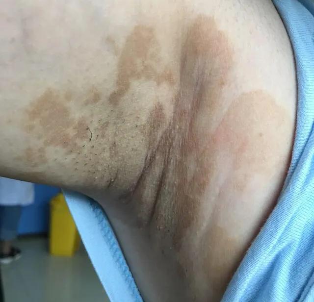 夏季汗多如何治疗,夏天汗斑的最佳治疗方法