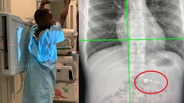 一岁小孩吞无线耳机,男孩误吞无线耳机