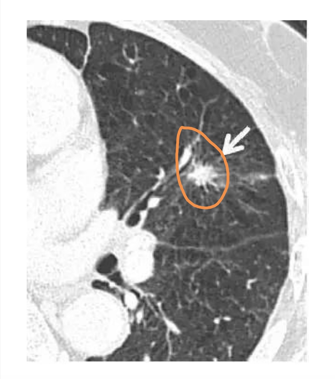 肺小结节4mm半年会不会发展成肺癌,两肺多发小结节是肺癌的前兆吗