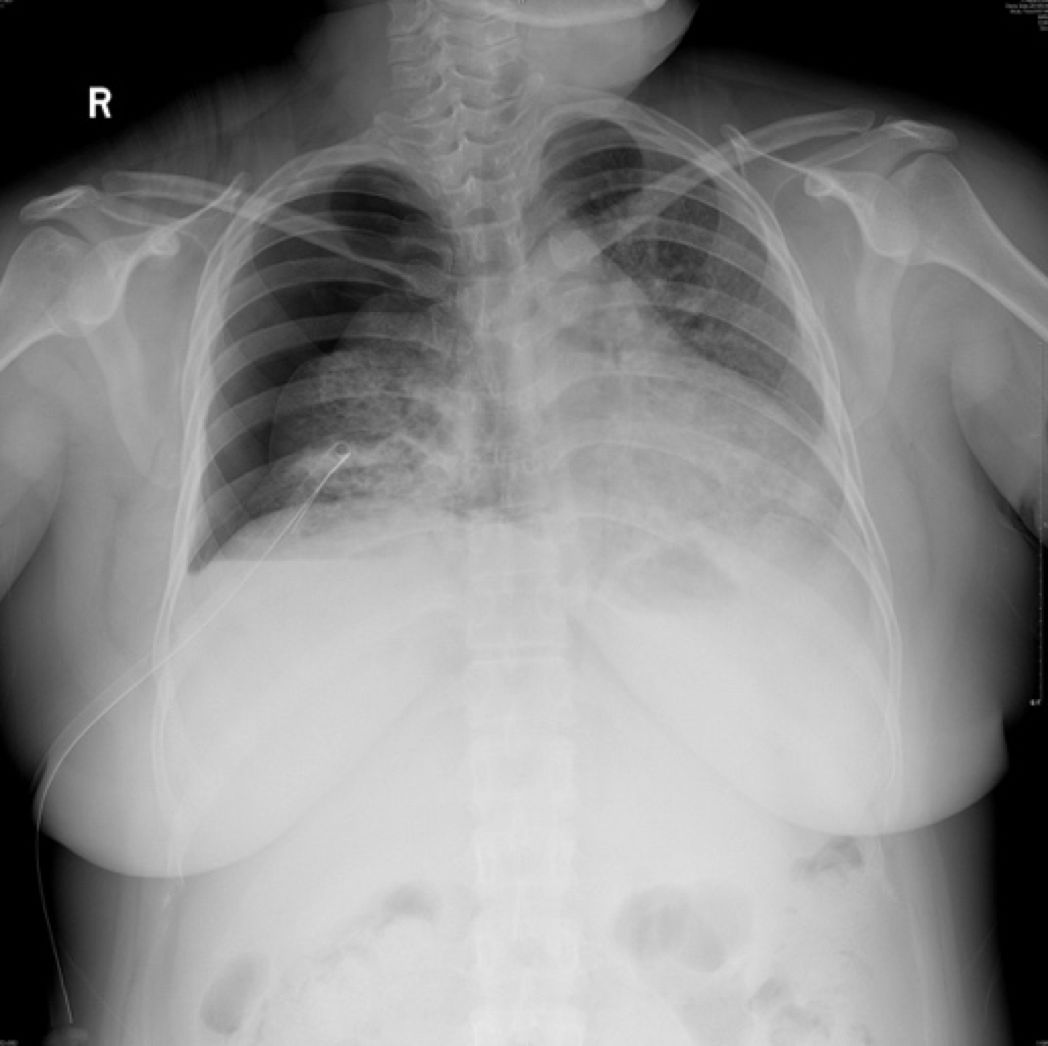 女性气胸的十大症状,女性气胸的十个表现