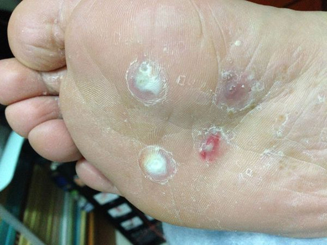 脚上长鸡眼有什么特征,脚上长了鸡眼如何防止感染