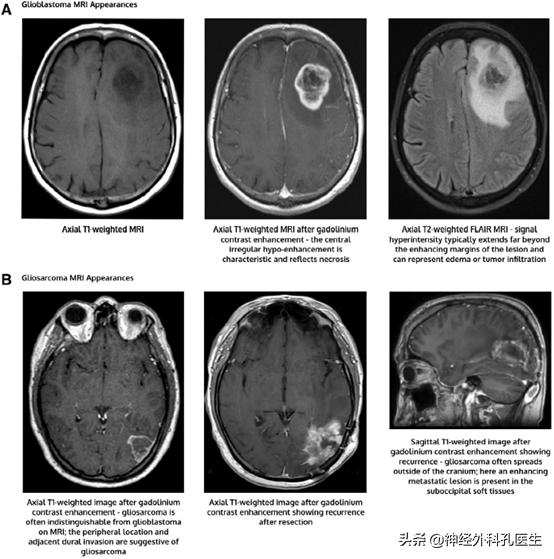 胶质母细胞瘤2024年新药,新诊断胶质母细胞瘤患者生存期
