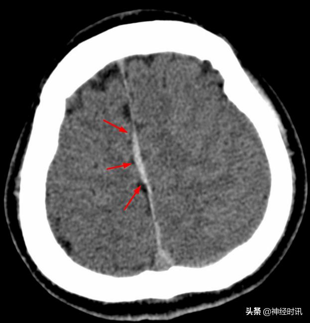 蛛血的临床表现,蛛血ct表现