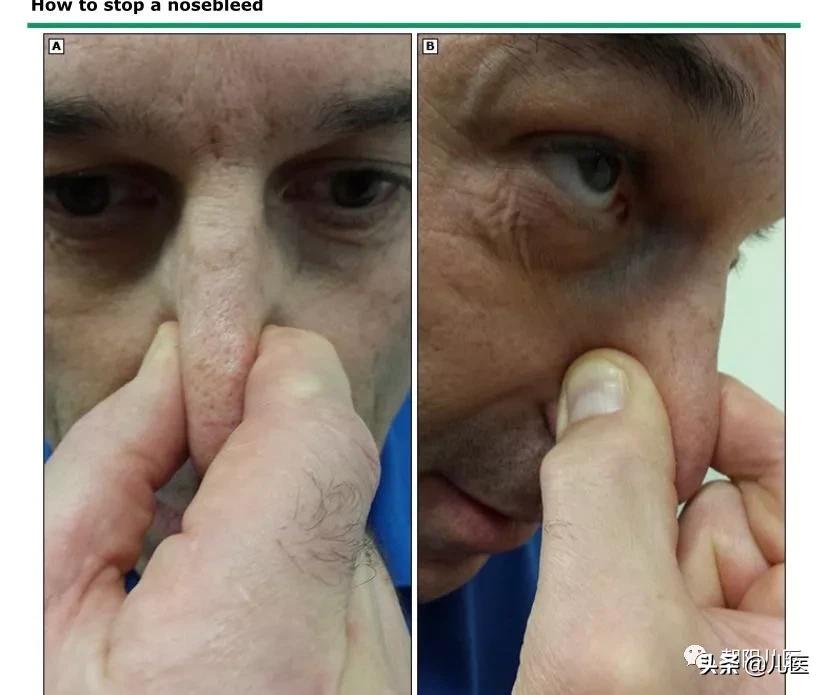 反复鼻出血,鼻出血的应对措施